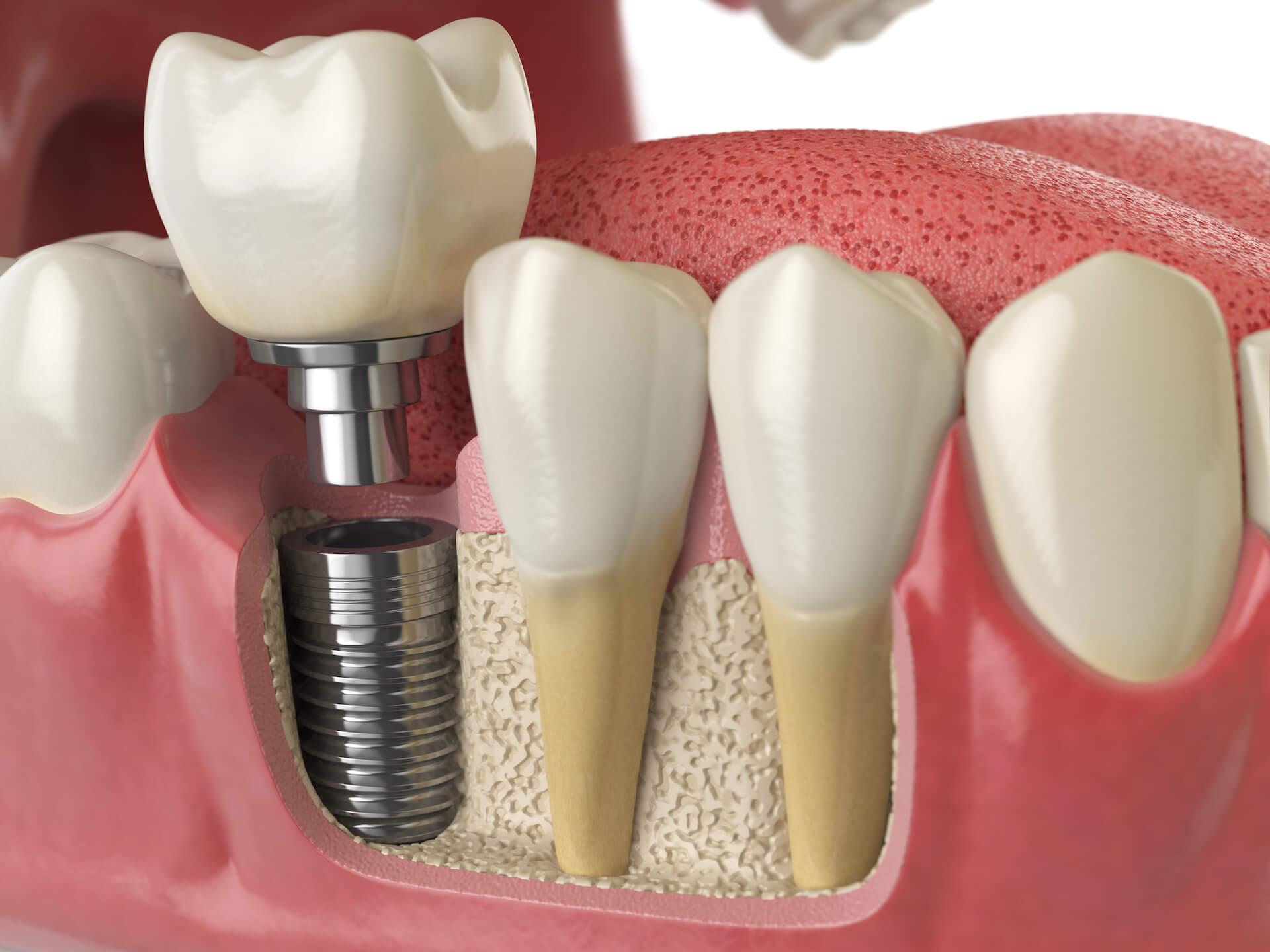 Advancements in Dental Implant Procedures in Richmond