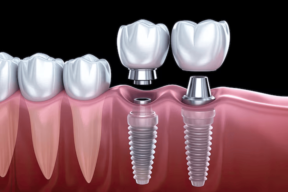 Reimagining Patient-Centric Care in Dental Implantology